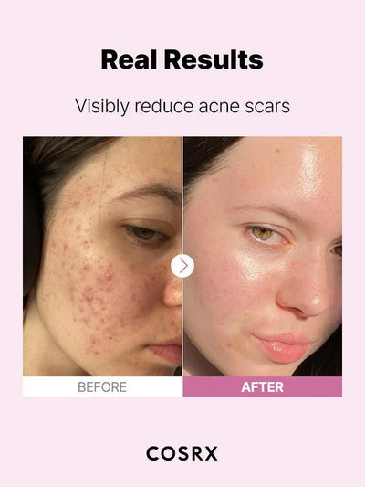 COSRX The Niacinamide 15 Serum – Powerful Oil Control &amp; Skin Brightening